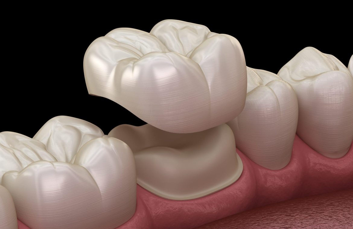 Dental Crowns